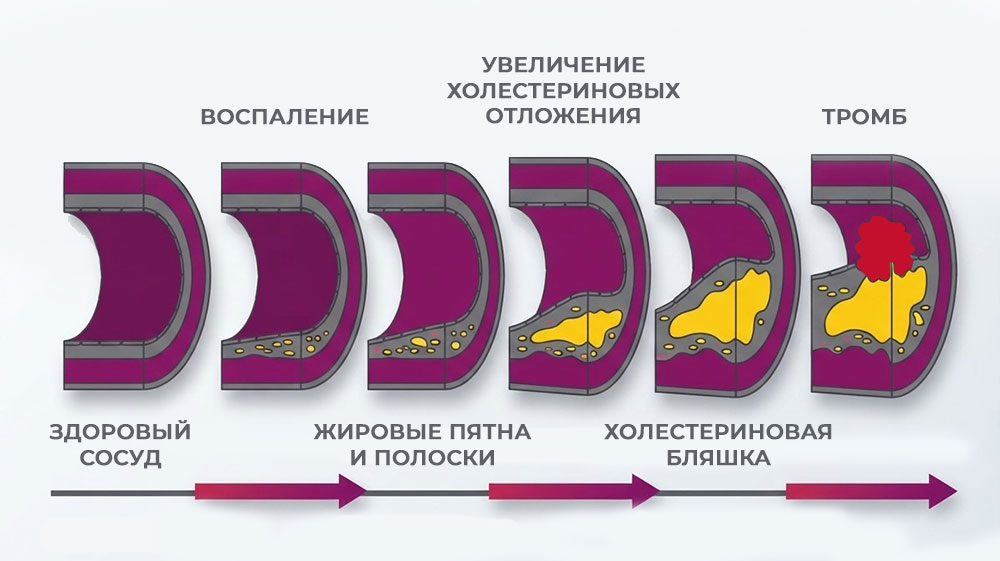развитие-атеросклероза
