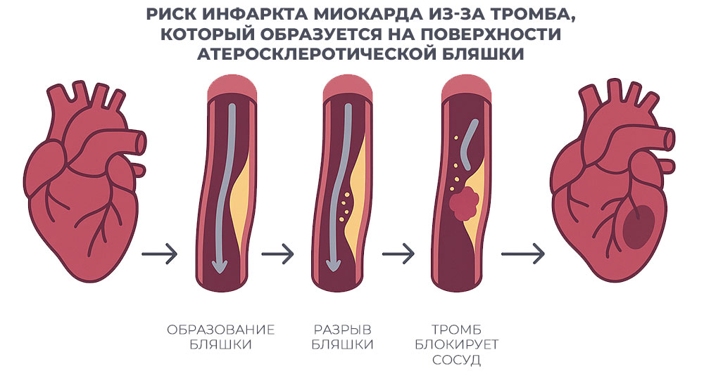 инфаркт-миокарда-из-за-тромба-схема